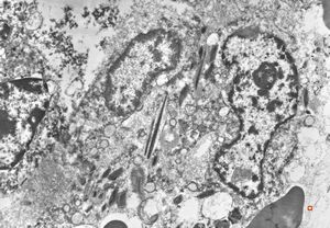 bone marrow - crystalloid inclusions Charcot-Leyden crystals formation v.s.